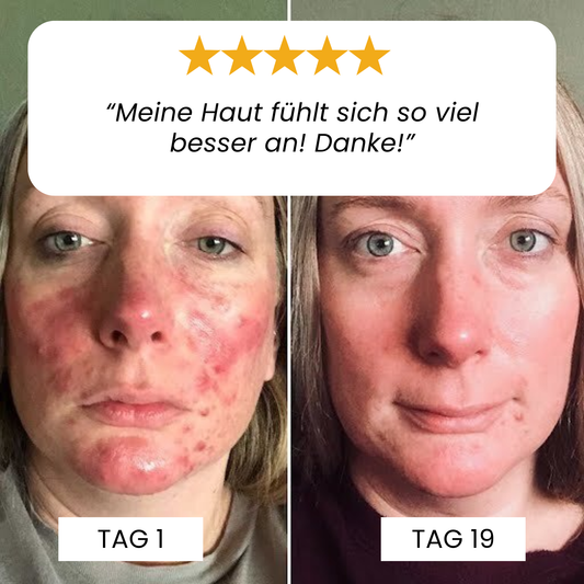 Rötungsstopp Rosazea Balsam